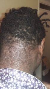 eczema at back of head