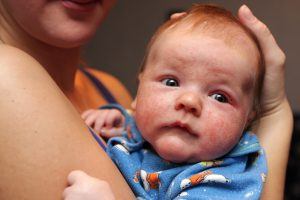 Mum holding baby with face eczema