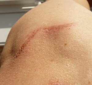skin with scar